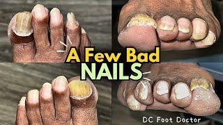 A Few Bad Nails: Trimming Fungal Toenails