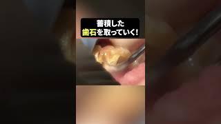 【歯石除去】歯磨きしないと歯石がつくぞー！#歯医者#歯石除去  #dentist #歯磨き