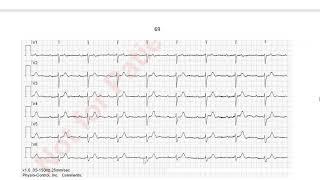 EKG in 3 Minuten [6]