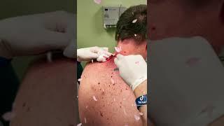 Dr. Greenberg Cyst Follow up video  with Las Vegas Dermatology® incision & drainage procedure  