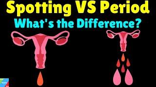 What is the difference between Spotting and Period? – Spotting VS Period