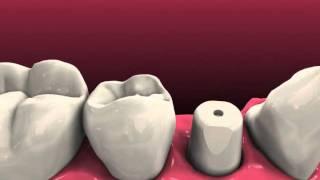 Simple Solutions Dental Restorations