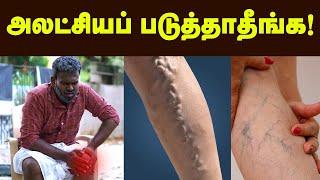 Varicose Vein: ரொம்ப நேரம் நிப்பீங்களா? - Position-அ இப்டி மாத்துங்க! Health tips | Doctor Tamil