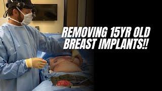 Breast Implant Capsular Contracture Explanted with En Block Capsulectomy