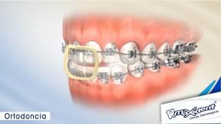 Corrección de mordida y espacios dentales "Ortodoncia"