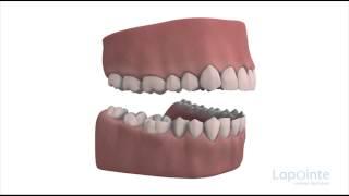 Conséquences d'une malocclusion - Centres dentaires Lapointe