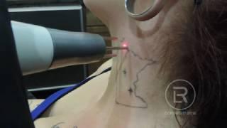 MN Outline Neck Session 3 Laser Tattoo Removal