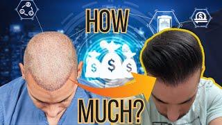 How Much Does A Hair Transplant Cost