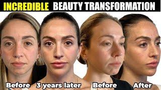 Incredible non-surgical Beauty Transformation!- Botox, Filler, Sculptra?