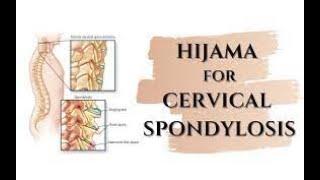 Hijama  For CERVICAL SPONDYLOSIS | Cupping therapy | Healthistan