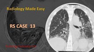 Patient presented with dry cough and SOB | Radiology FRCR RS  case 13