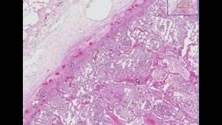 Histopathology Lung --Lobar pneumonia