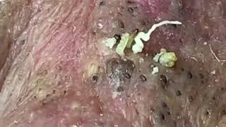 BLACKHEAD REMOVAL on Senior | Pimple Popping YouTube Video