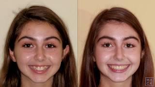 Braces Before and After with Reshaping of Front Teeth