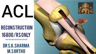 Arthroscopic / OPEN   repair  of A C L  Ligament @suryadrsksharma8008