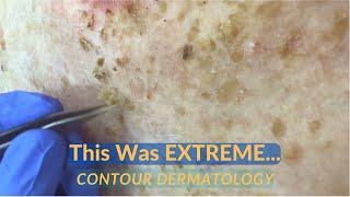 SEVERE Debridement of Seborrheic Dermatitis Scale | CONTOUR DERMATOLOGY