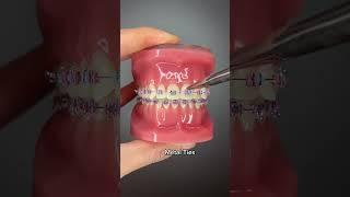 Different Types of Orthodontic Ties you can get at your Orthodontist Part 1