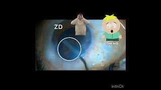Bowl formation. ZD. Managing it with Vitrectomy and PCIOL-My first