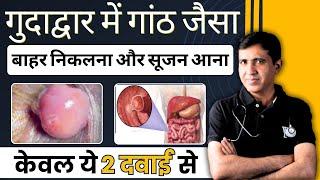 Anus Swelling | गुदाद्वार का बाहर आना | गुदाद्वार की सुजन का कारण, लक्षण व इलाज