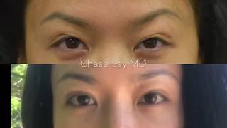 #ChaseLayMD Asian Eyelid Surgery: 7 Time Revision