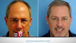 Hair Transplant for Job Interview - Dr. Scott Boden