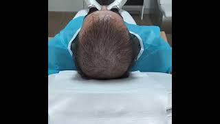 Feyyaz YAVUZ Saç Simülasyonu (Scalp Aesthetic Center)