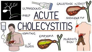 Understanding Acute Cholecystitis