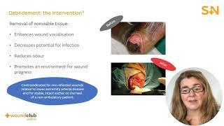 Wound Club Online | Module 9: T of T.I.M.E. - Tissue (Bitesize)