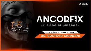 ANCORFIX | Dr. Gustavo Giordani testa as Miniplacas