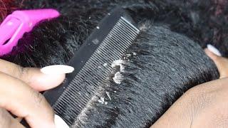 HUGE FLAKES |  DRY FLAKY SCALP | SCALP SCRATCHING EP27 #hugedandruff #scalpscratching