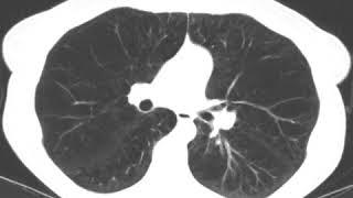 Subxiphoid Uniportal Lung Volume Reduction Surgery - Computed Tomography Scan