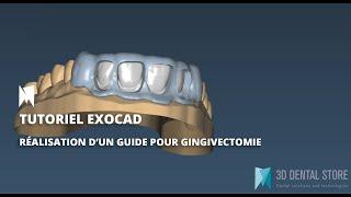 [EXOCAD] Tutoriel : Comment réaliser des gouttières de gingivectomie via Exocad 3D Dental Store?