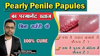 Pearly Penile Papules का इलाज-बिना सर्जरी के | Pearly Penile Papules treatment in Hindi | Dr. Nitish