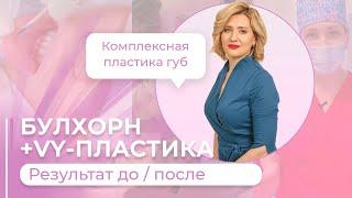 КРАСИВЫЕ ГУБЫ НАВСЕГДА / БУЛХОРН VY-ПЛАСТИКА / #кочнева #абриелль