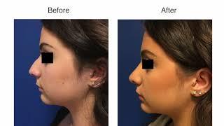 Rhinoplasty by Dr Damian Marucci