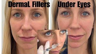 Dermal Filler Under Eyes Restylane