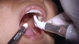 Dentalvibe dental anaesthesia with no pain