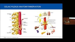 Interventional Therapies for Cancer Pain | Drs. Zion Zibly and Kanishka Rajput