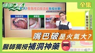 嘴破 是 火氣大 ？ 復發性 口腔潰瘍 小心 免疫功能 出狀況！健康2.0 20200905 (完整版)