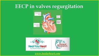 EECP in valves regurgitation