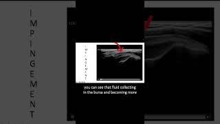 #Ultrasound Guided Interventions: Cases (Shoulder Impingement)