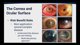 Tricks and Tips for Successful Therapeutic Scleral Lens Wear In Ocular Surface Disease