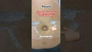 10 Sec Miracle! Laparoscopic Hernia Surgery by Nashik’s Best | Dr. Sachin Deore  #shorts #hernia