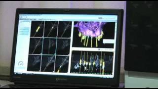 Dental Implants For Aging Teeth Problems. Mr Ng on life after dental implants.