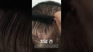 #40대 정수리 탈모치료 15회차 전후