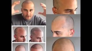 Scalp Micropigmentation - Review of the Scalp Aesthetics service