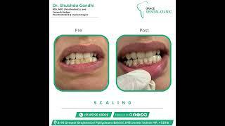 Grace Dental Clinic - Best Dental Clinic in Indore | Best Dentist in Indore