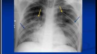 Chest x ray  interpretation -Tubes and Lines