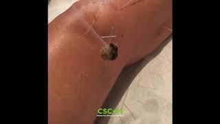 Knee Pain Treatment with Acupuncture and Moxibustion | CSC+M NYC