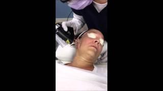 Fractional CO2 Laser Skin Resurfacing, Laser Skin Rejuvenation, Burke, VA Skin Deep Laser Services